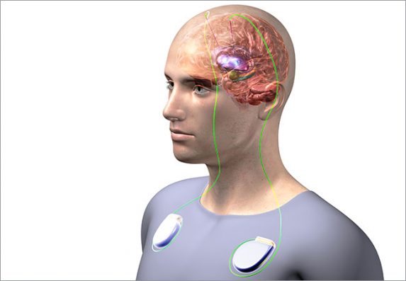 Deep Brain Stimulation Untuk Pasien Kecanduan Obat